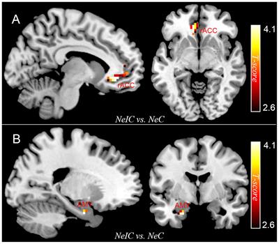 Fronto-Limbic Alterations in Negatively Biased Attention in Young Adults with Subthreshold Depression